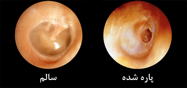 مقدمة كاملة عن جراحة تمزق طبلة الأذن وأهميتها