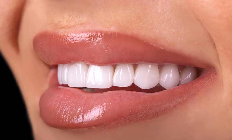 مقدمة كاملة عن صفائح الأسنان وفوائدها